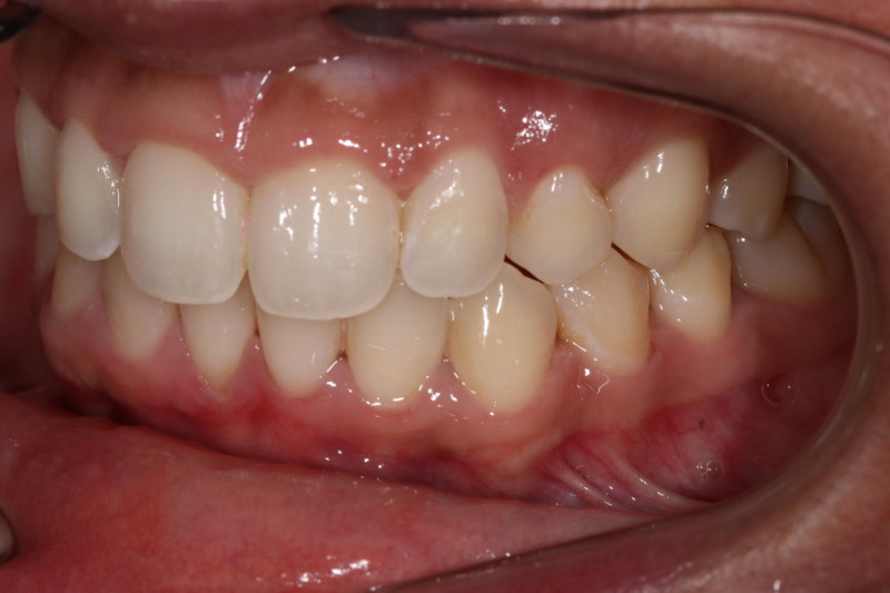 straight teeth with invisalign
