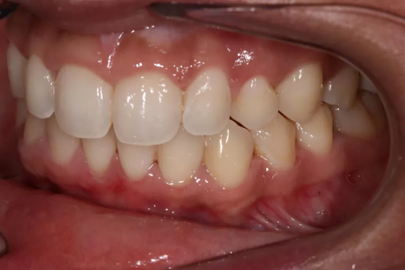 After Invisalign straight teeth with invisalign