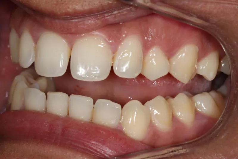 Before Invisalign teeth with gaps Before Invisalign teeth with gaps