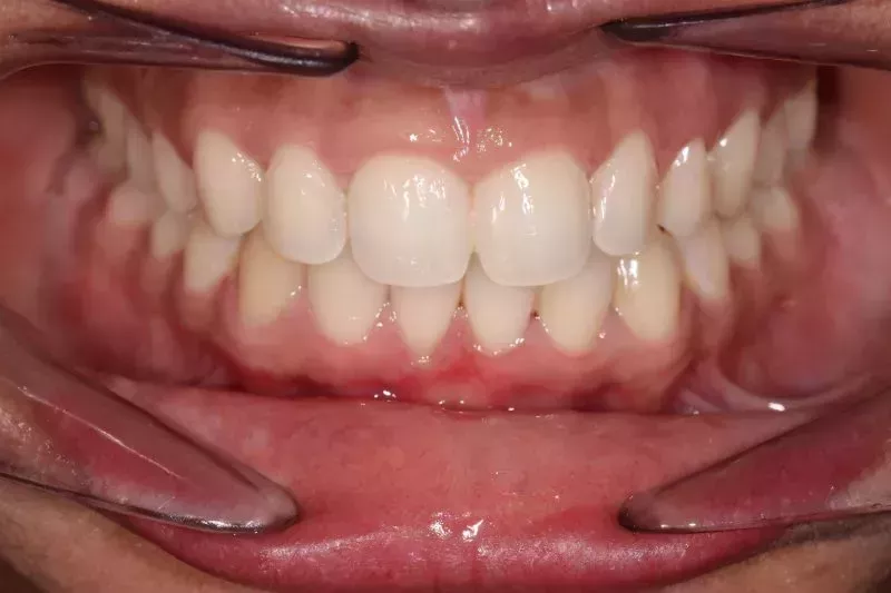 After Invisalign After Invisalign