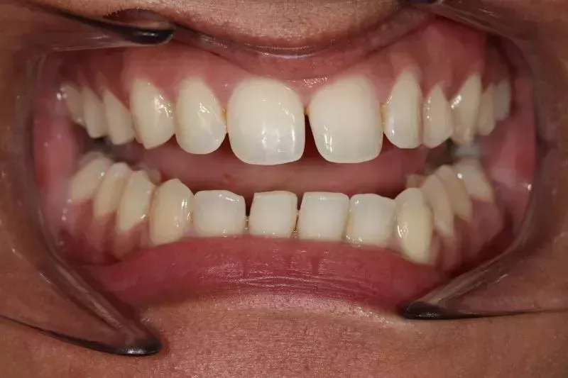 Before Invisalign Before Invisalign