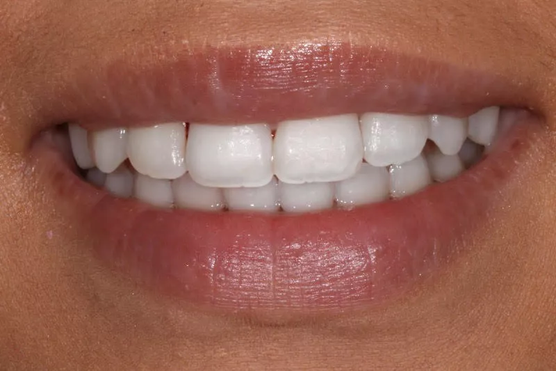 Fixed Braces and Whitening Fixed Braces and Whitening