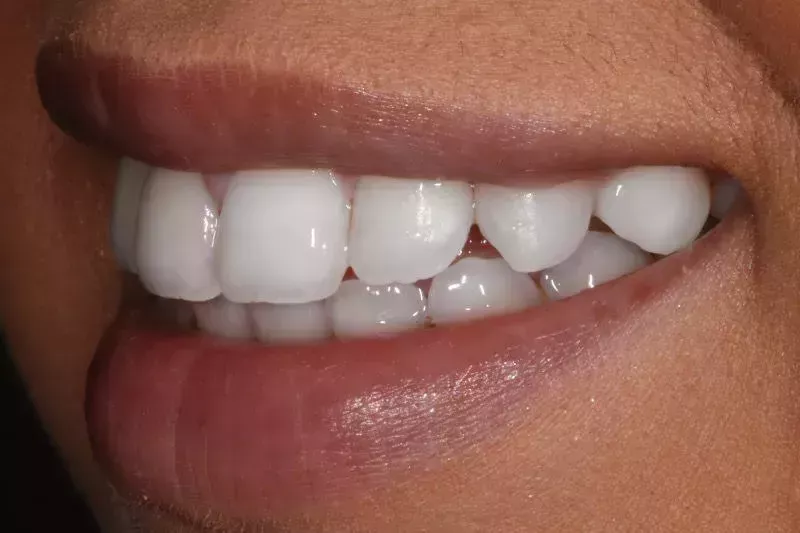 Fixed Braces and Whitening