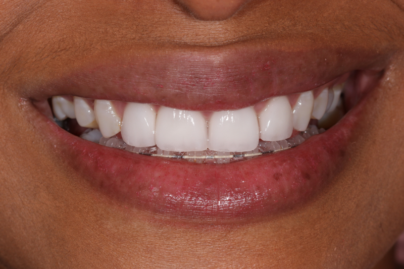 Porcelain Veneers