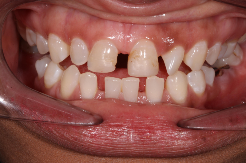 Porcelain Veneers