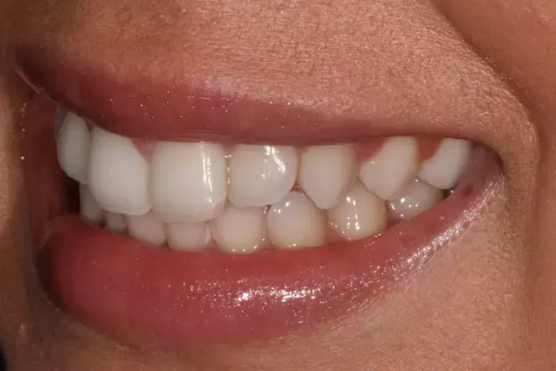 Fixed Braces and Whitening