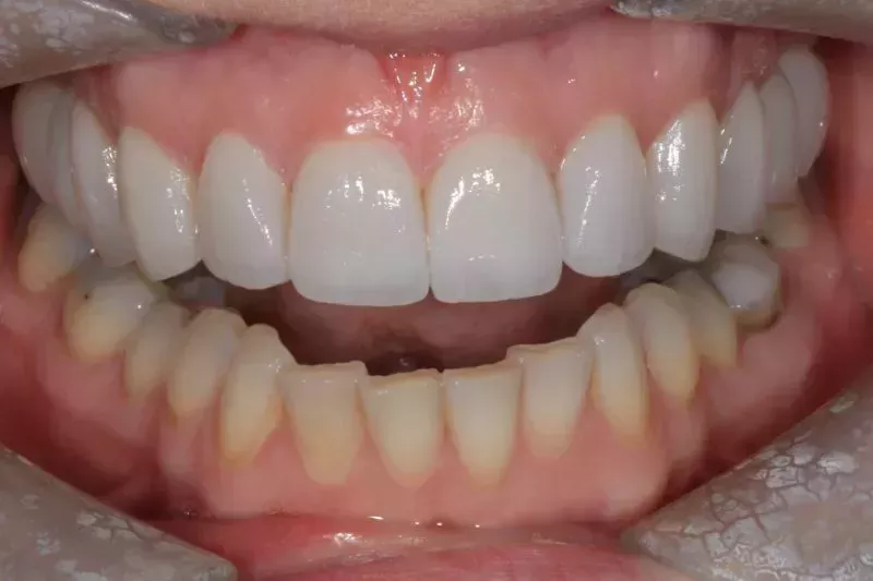 10 veneers and one implant