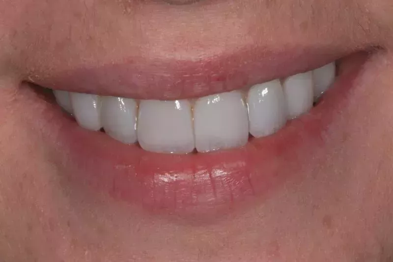 10 veneers and one implant