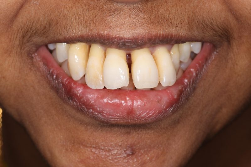 Before all on 4 dental implants