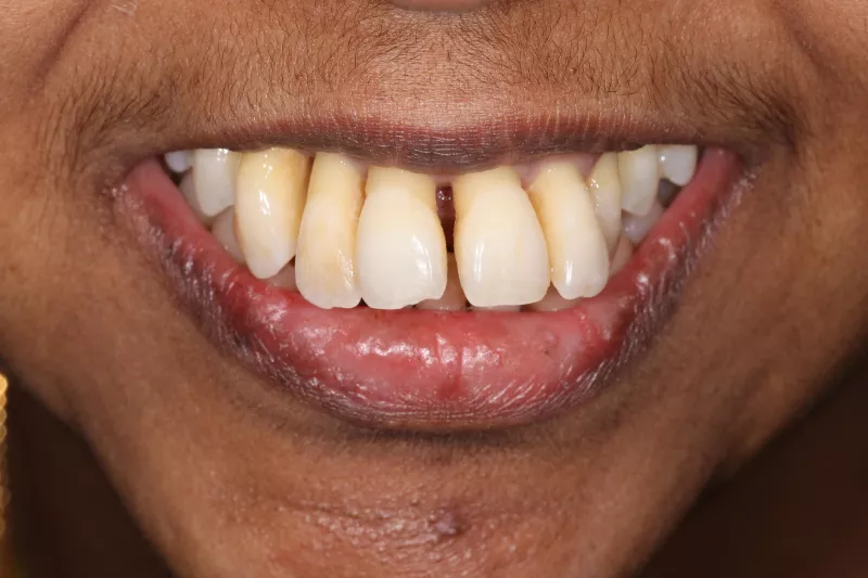 Before all on 4 dental implants