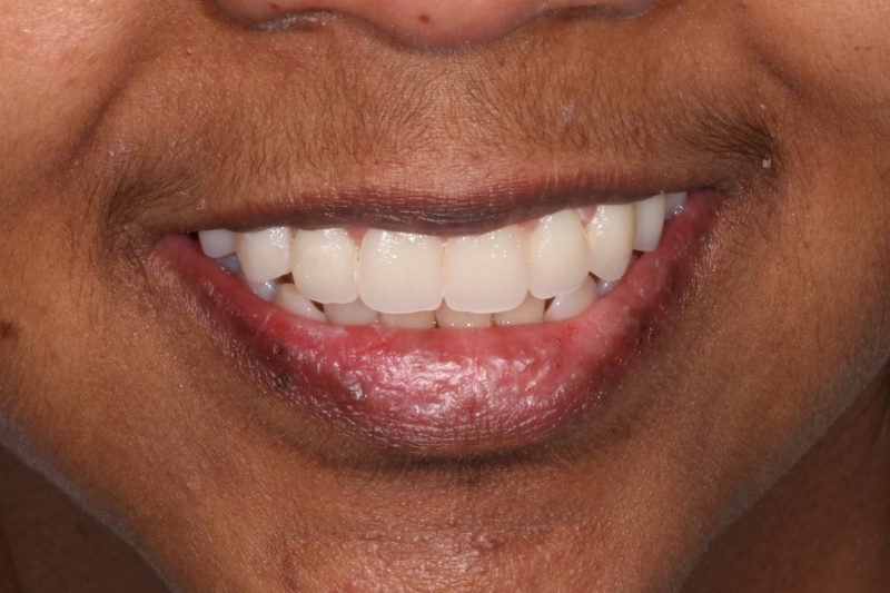 all on 4 dental implants