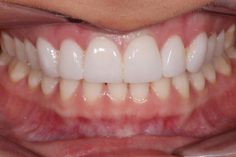 No damage porcelain veneers