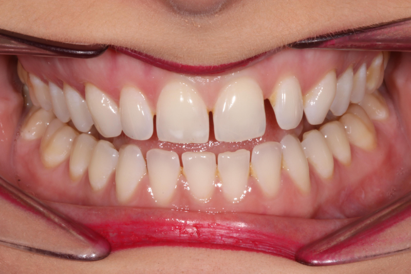 Before dental veneers