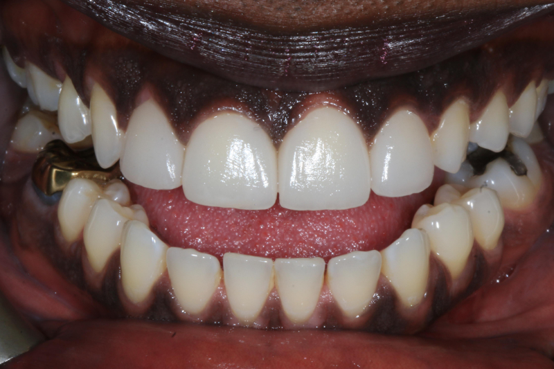 After dental veneers