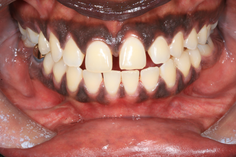 Before dental veneers