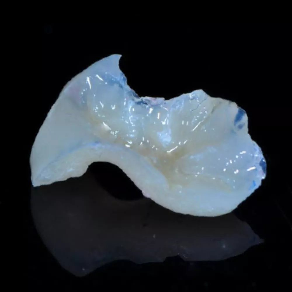 Composite bonding The Knightsbridge Clinic Lifelike composite bonding veneers at The Knightsbridge Clinic