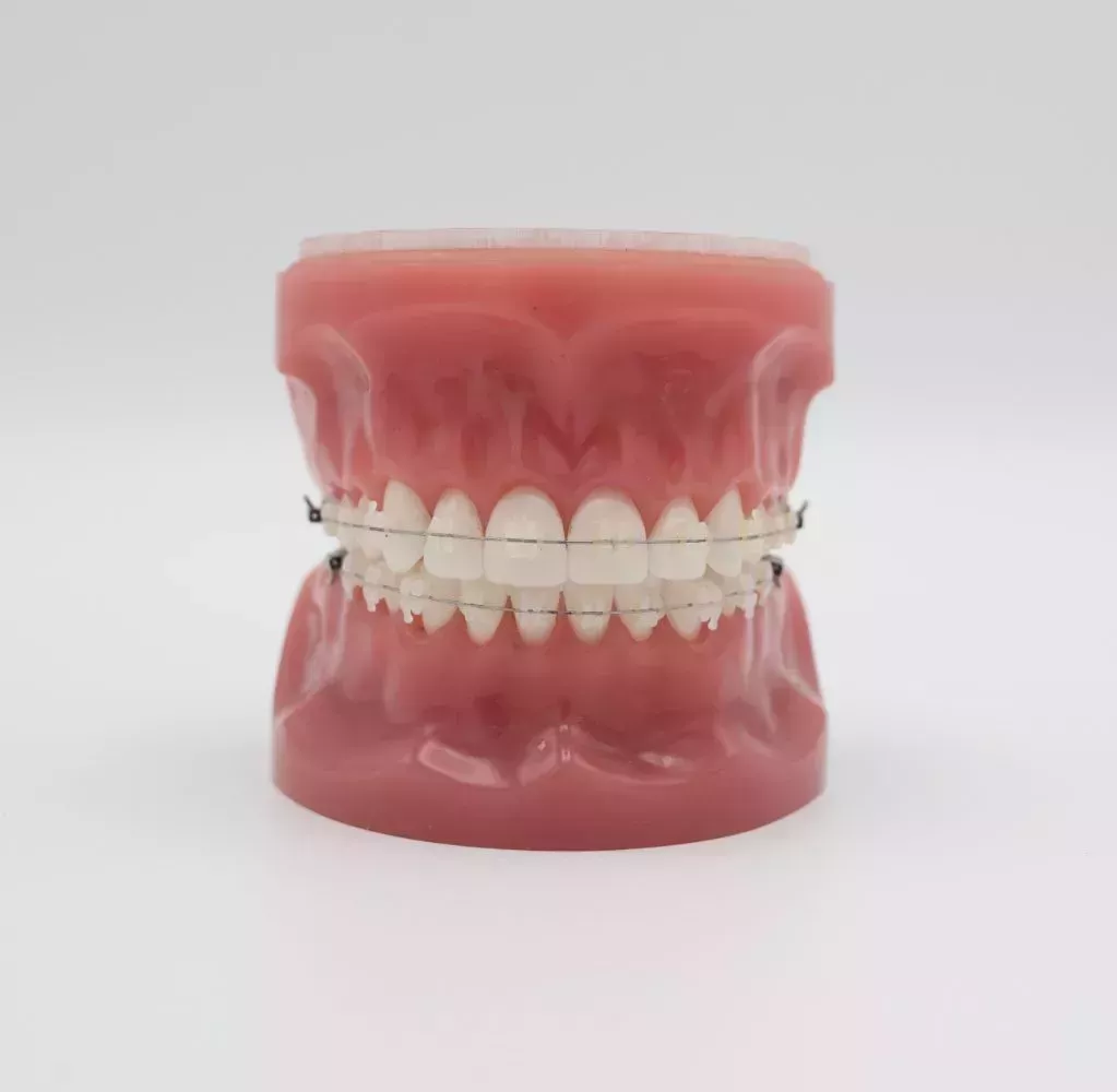 Fixed Braces by Dr Sheraz Aleem