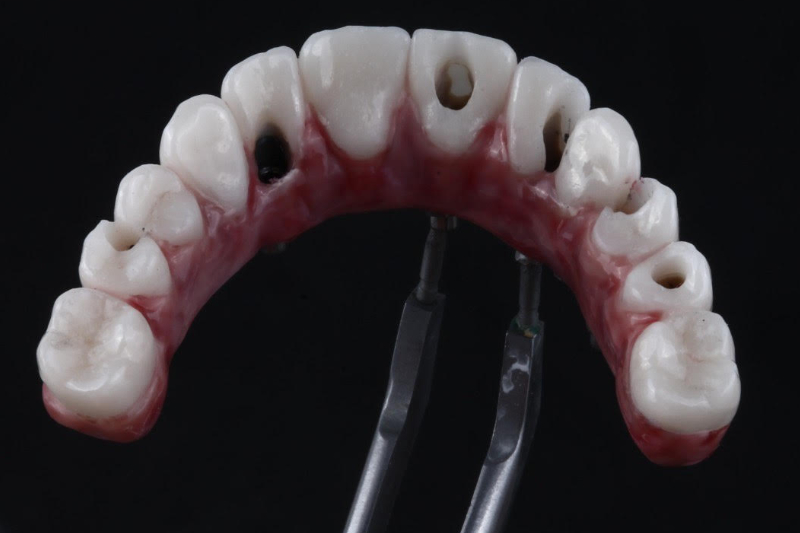 The best alternative to dentures, all on 6 dental implants