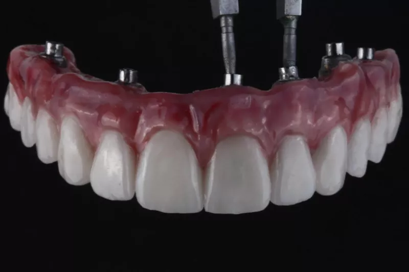 Full arch case same day all on 6, all on 4 dental implants by Dr Sheraz Aleem