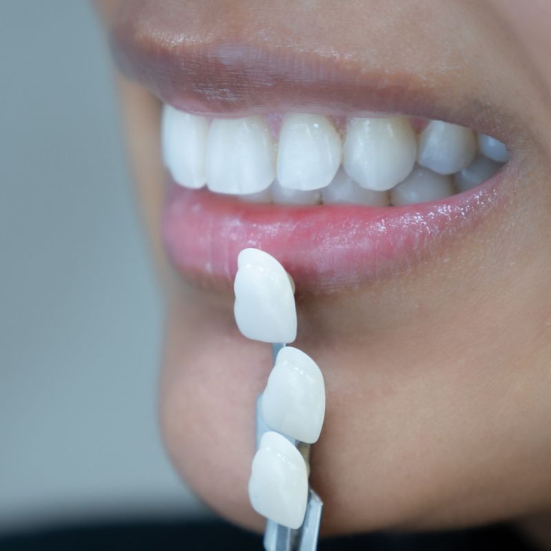 Teeth Whitening Knightsbridge & Kensington