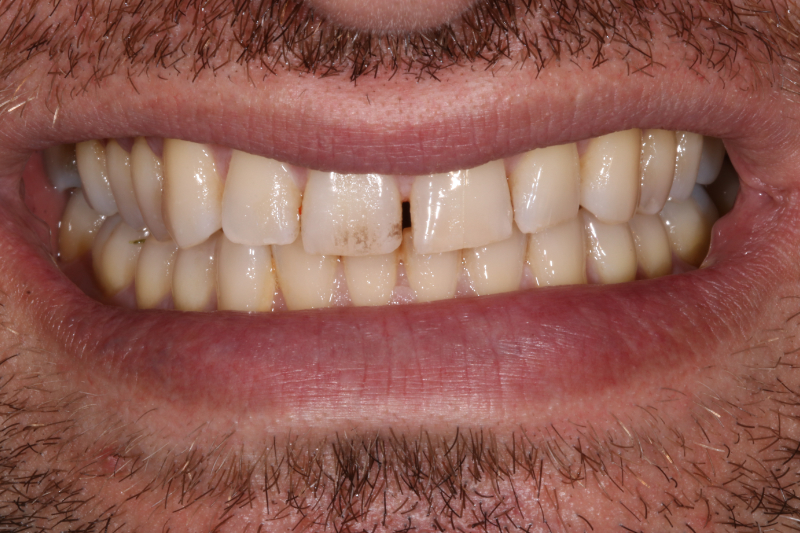 Before porcelain veneers