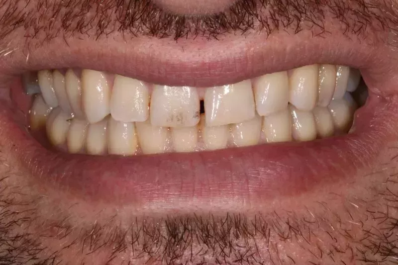 Before porcelain veneers