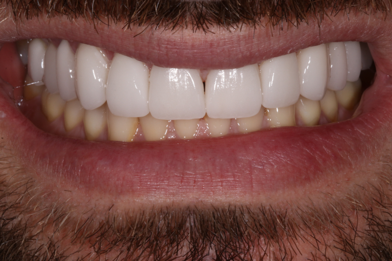Porcelain Veneers