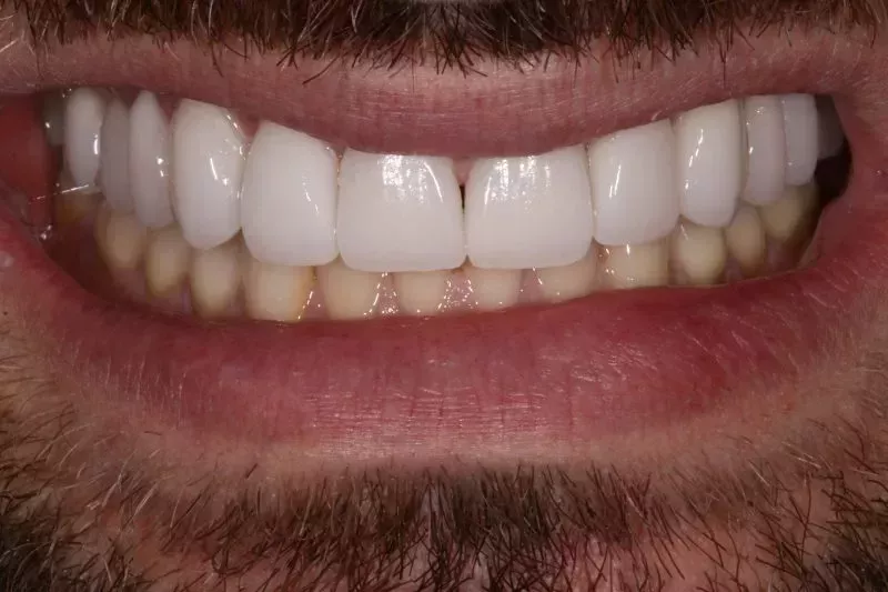 Porcelain Veneers