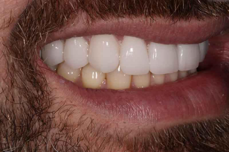 After porcelain veneers