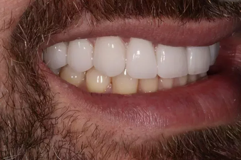 After porcelain veneers