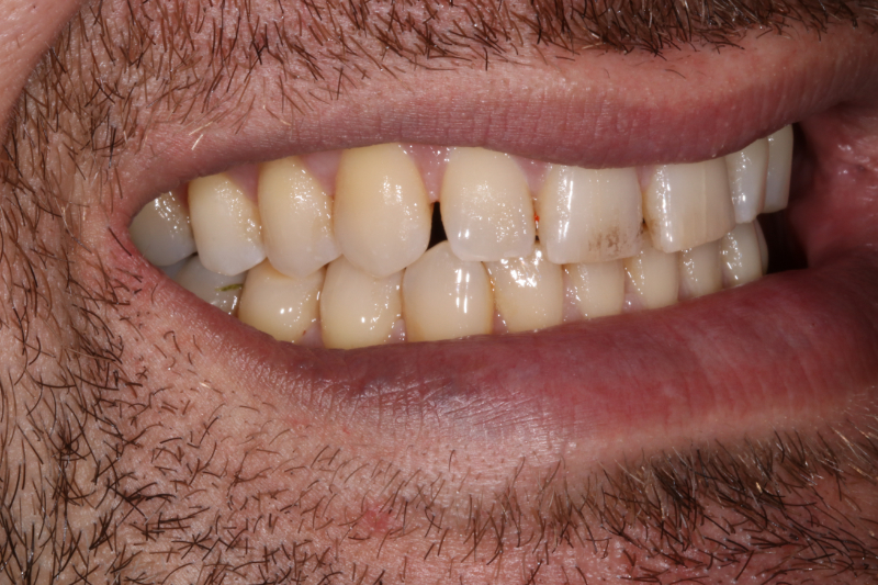 before porcelain veneers