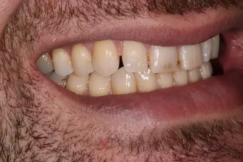 before porcelain veneers