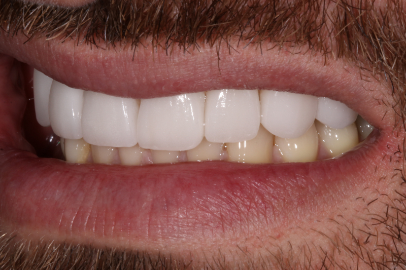 No damage porcelain veneers