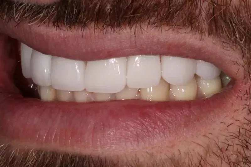 No damage porcelain veneers