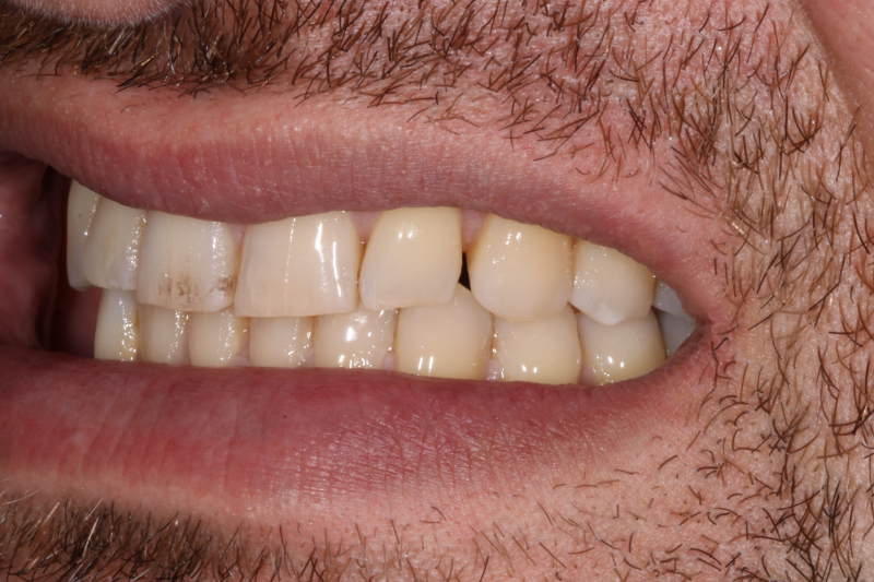 Before porcelain veneers