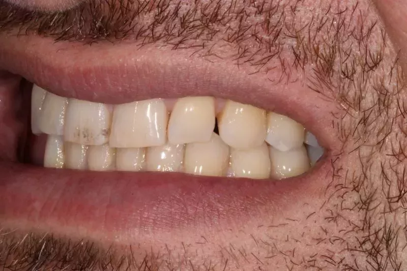 Before porcelain veneers