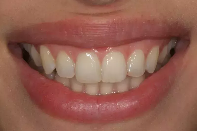Composite veneers