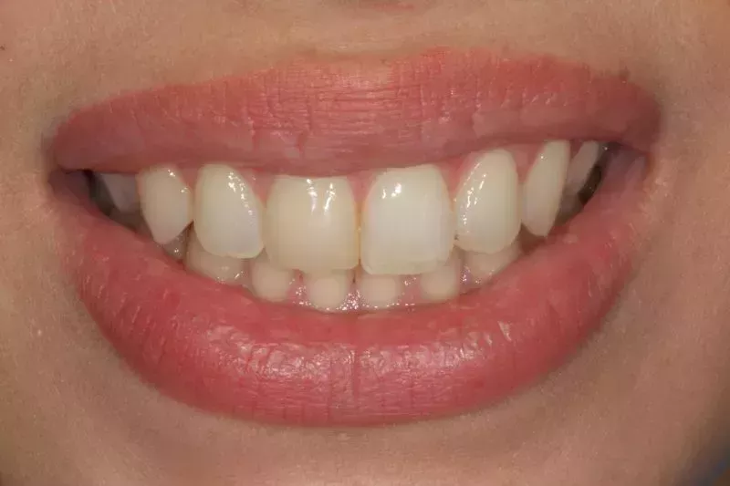 Composite veneers