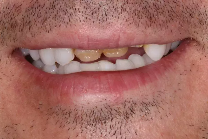 Dental Implant and cerec crown