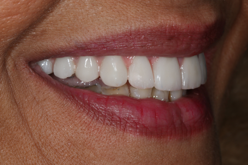 Natural full mouth restoration with dental implants