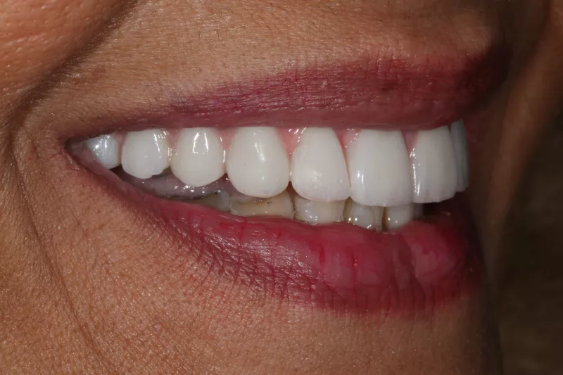 Full arch all on 6 teeth Natural full mouth restoration with dental implants