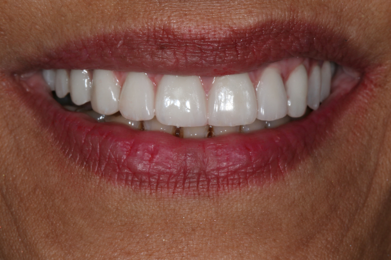 Lifelike dental implants replacing missing teeth