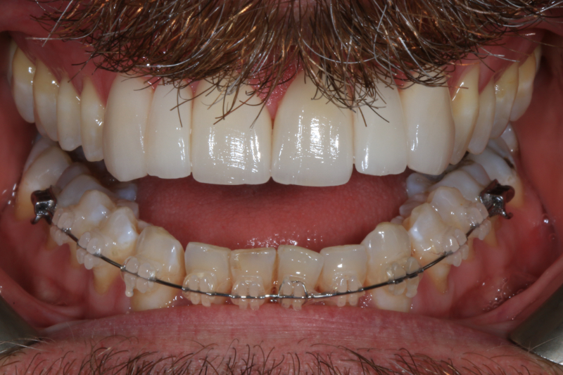 Fixed braces and veneers