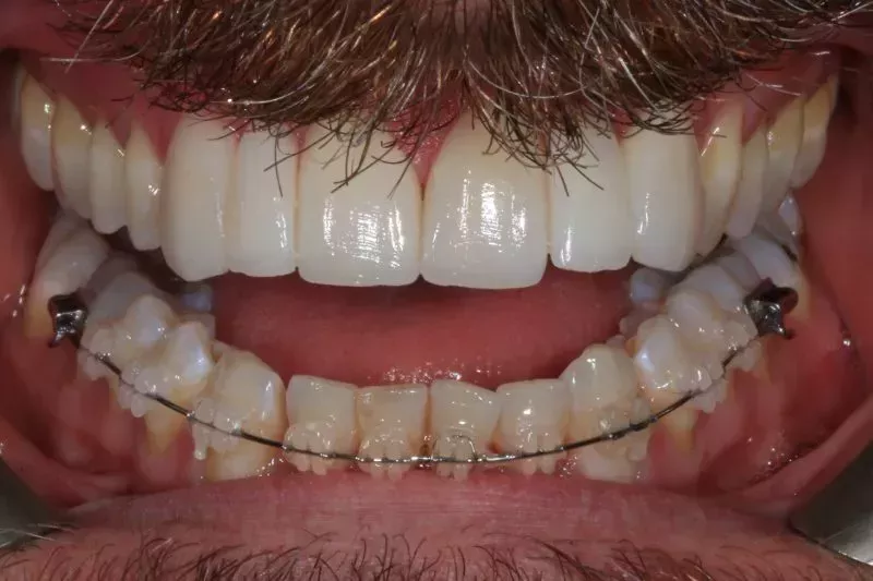 Fixed braces and veneers
