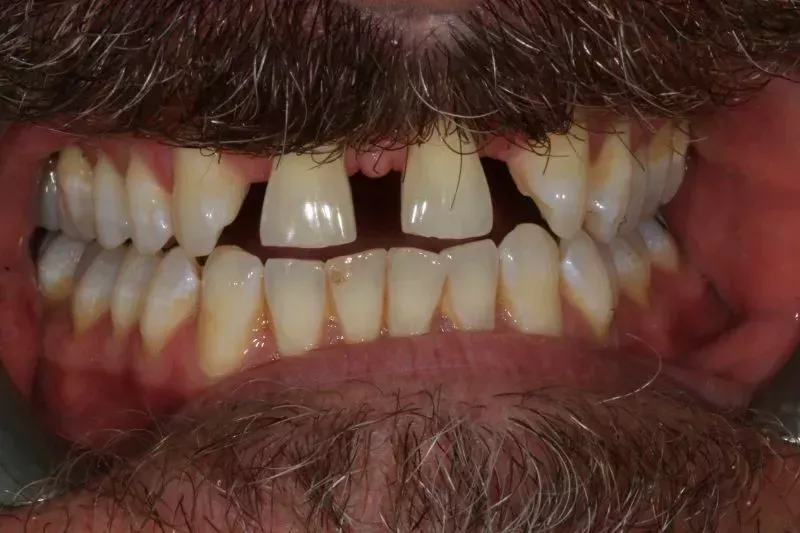 Fixed braces and veneers