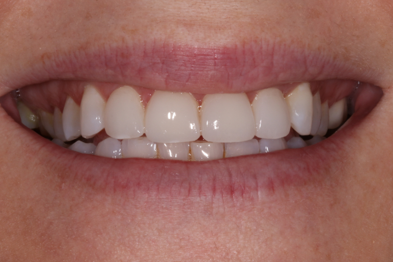 After porcelain veneers