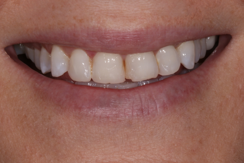 Before porcelain veneers