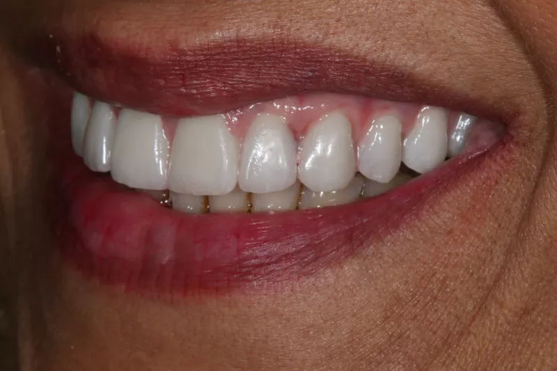 Full arch case Highly experienced doctors replacing full mouth missing teeth