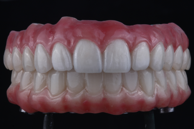 Full mouth implants with natural porcelain crowns