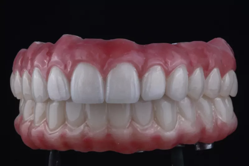 All on 6 dental implants by TKC Same day loading implants at The Knightsbridge Clinic